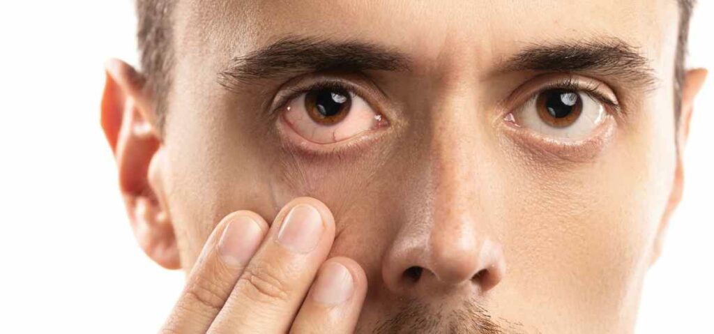 Apa Itu Mata Kering? Mata kering adalah kondisi yang terjadi ketika jumlah atau kualitas air mata tidak mencukupi untuk melumasi mata.
