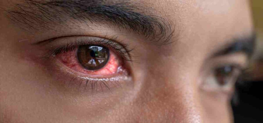 Mata merah sebelah adalah kondisi di mana pembuluh darah di sklera (putih mata) mengalami pembengkakan atau pelebaran.