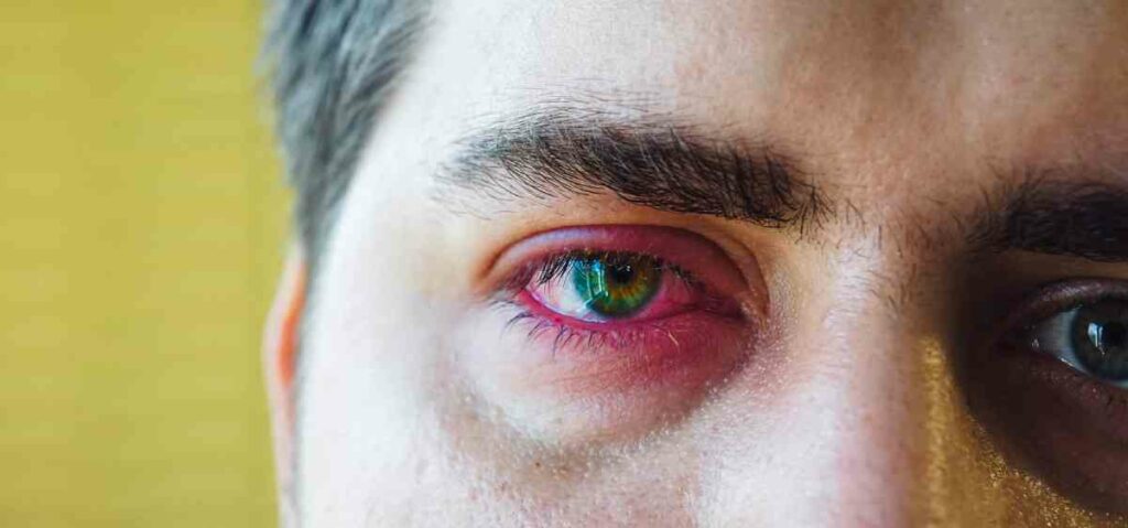 Ada banyak penyebab mata bengkak, entah itu bengkak akibat iritasi, kurang tidur, atau bahkan karena kanker mata.