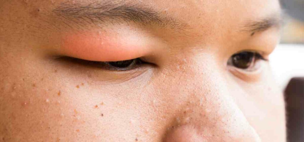 bengkaknya mata secara terus menerus bisa menjadi pertanda penyakit ginjal.