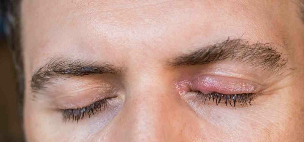 Cara menghilangkan bengkak di bawah mata bisa melalui penggunaan obat mata, tetapi bisa juga hilang dengan sendirinya tanpa pengobatan.