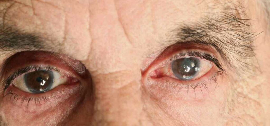 Ada banyak jenis katarak yang dibedakan berdasarkan usia penderita, penyebab mata katarak, hingga letak kekeruhan di lensa mata.