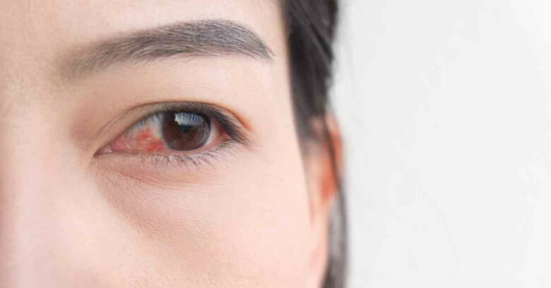 Mata merah disebabkan oleh banyak hal mulai dari alergi, iritasi, dan lainnya.