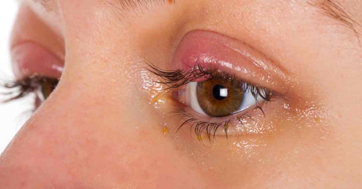 6 Cara Menghilangkan Bengkak di Mata, Apa Saja Penyebabnya?