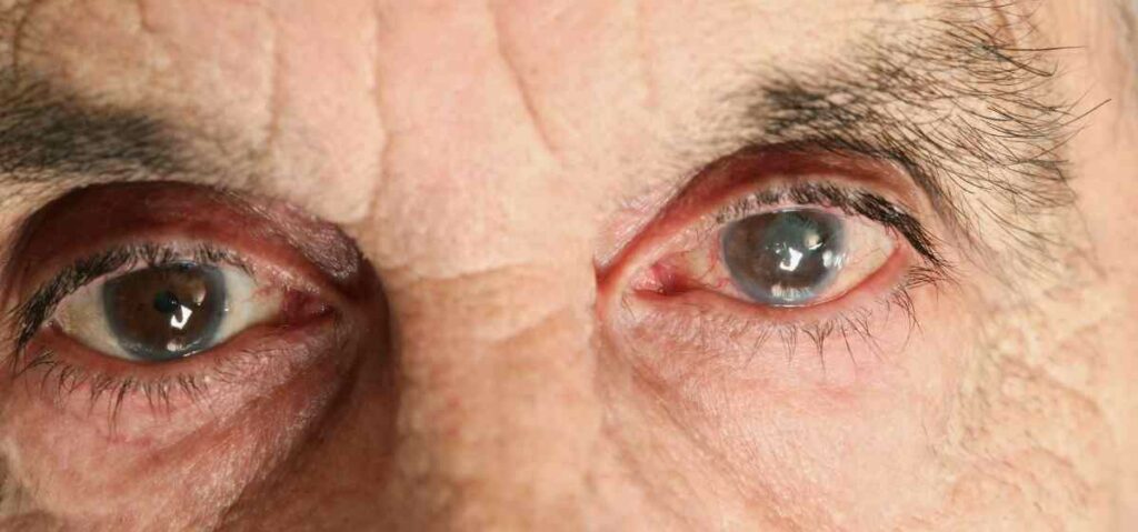 Penyakit gangguan penglihatan katarak akan membuat lensa mata seperti berawan dan membuat penglihatan yang kabur pada awalnya. 