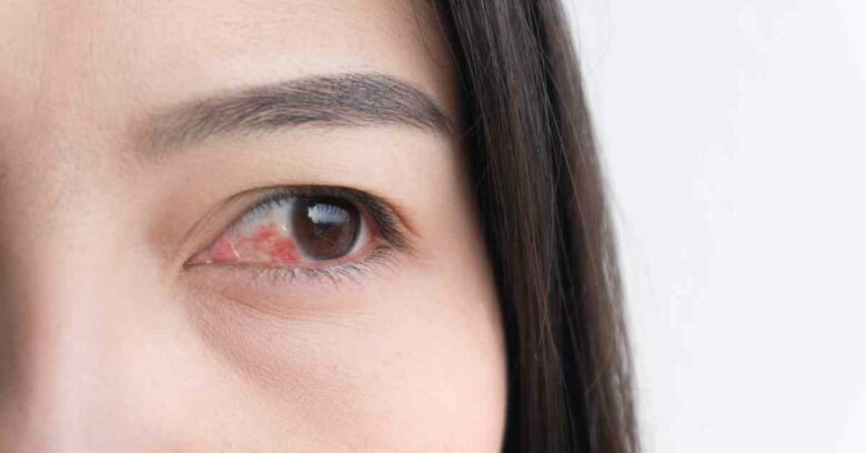 Mata kering merupakan kondisi ketika mata mengalami gangguan pada permukaan mata, yang ditandai dengan ketidakstabilan produksi dan fungsi dari lapisan air mata.