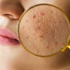 Apakah Serum Vitamin C Bagus Untuk Kulit Berjerawat?