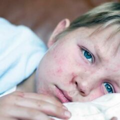 Dosis dan Manfaat Vitamin A untuk Infeksi Campak pada Anak