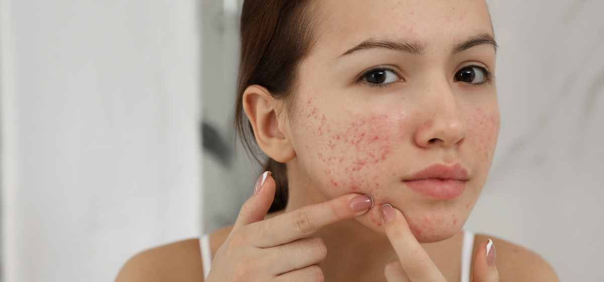 manfaat vitamin e untuk kulit Mencegah timbulnya jerawat