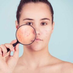 Apakah Vitamin E Cocok untuk Kulit Berjerawat?