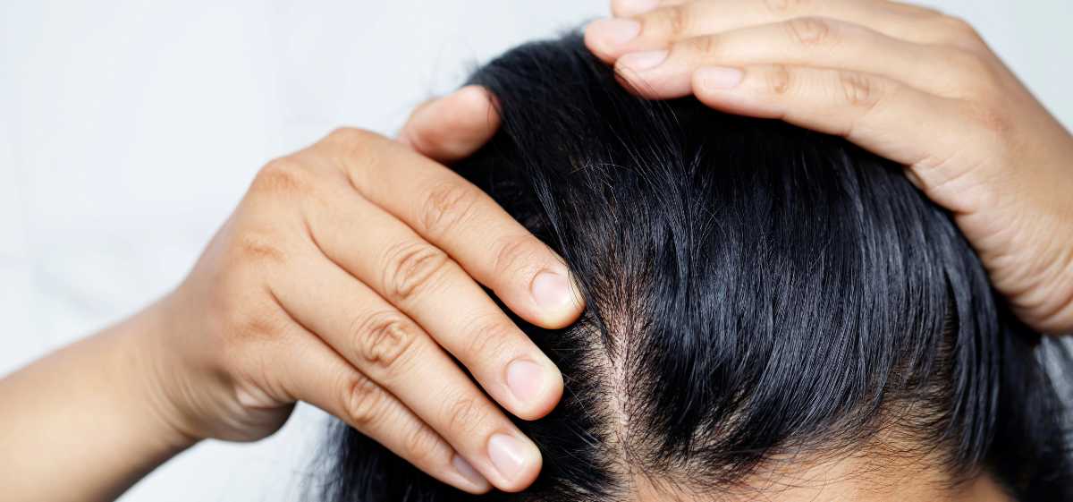Apakah vitamin E bisa melebatkan rambut?

Vitamin E dapat membantu meningkatkan kesehatan rambut dan mencegah kerusakan pada akar rambut, namun tidak secara langsung dapat melebatkan rambut.