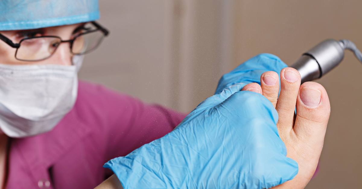 Cara mengobati mata ikan di kaki adalah dengan menggosok kulit mati dengan batu.