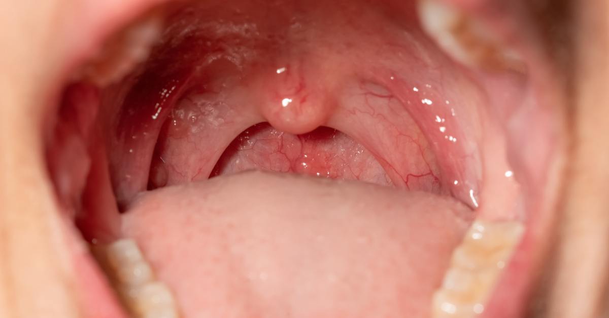 ciri ciri radang tenggorokan akan sembuh adalah menghilangnya gejala radang tenggorokan, seperti demam atau tenggorokan gatal.