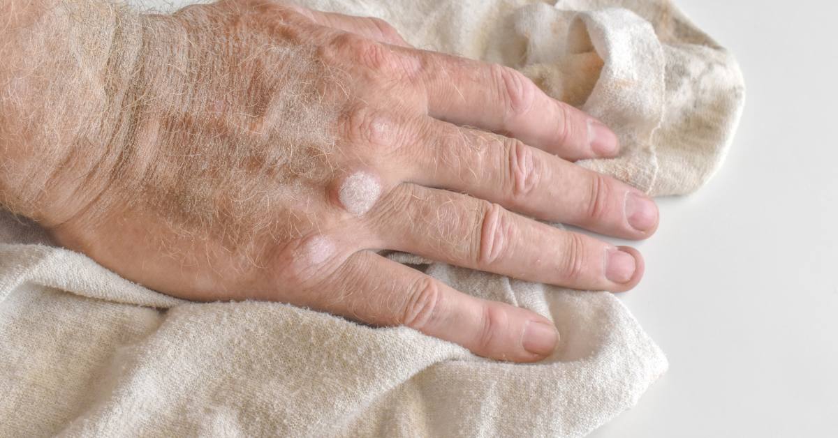 Gejala mata ikan adalah mengalami benjolan kecil yang kadang terasa nyeri.