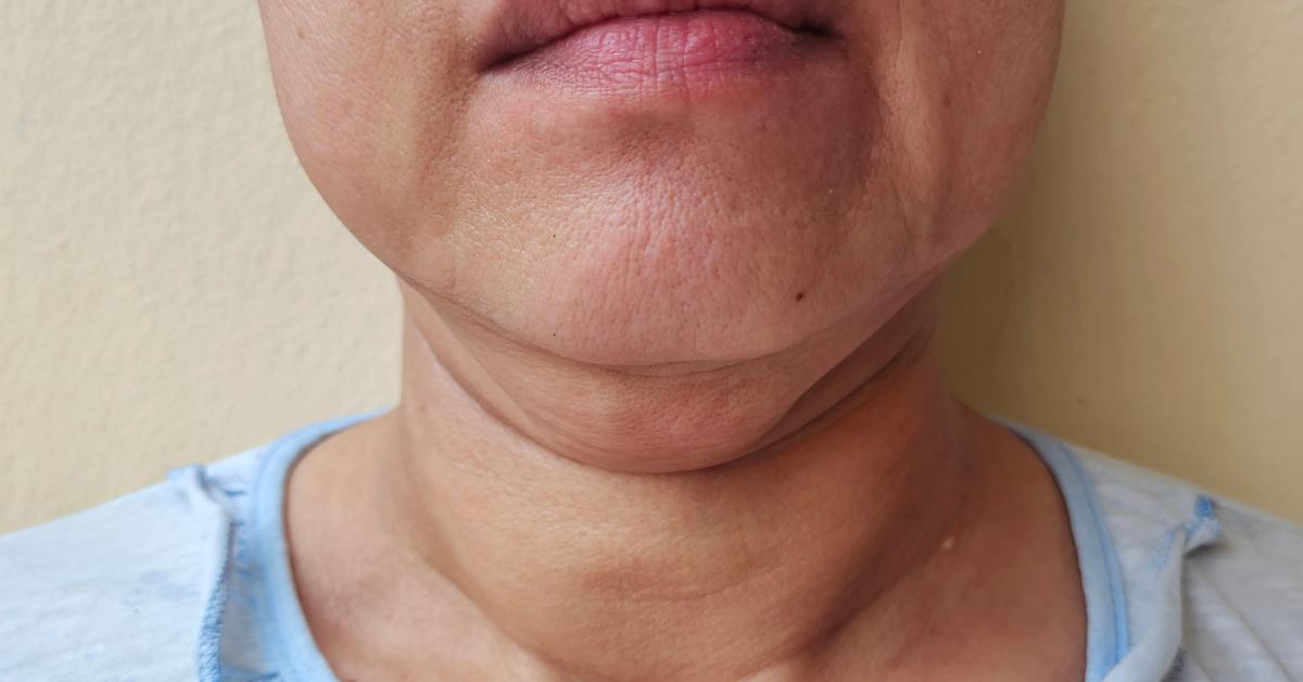 Benjolan di leher bisa terjadi karena gondongan.