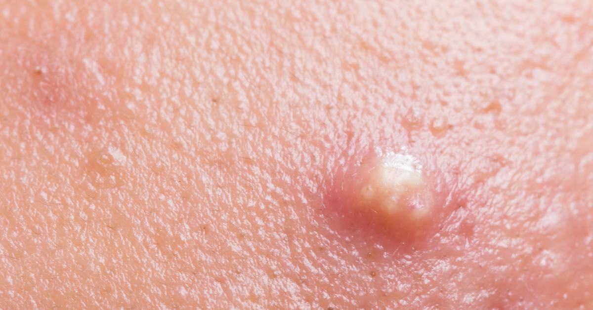 Benjolan di leher bisa disebabkan oleh jerawat.