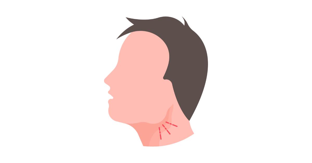 Benjolan di leher bisa saja terjadi karena karsinoma sel basal.