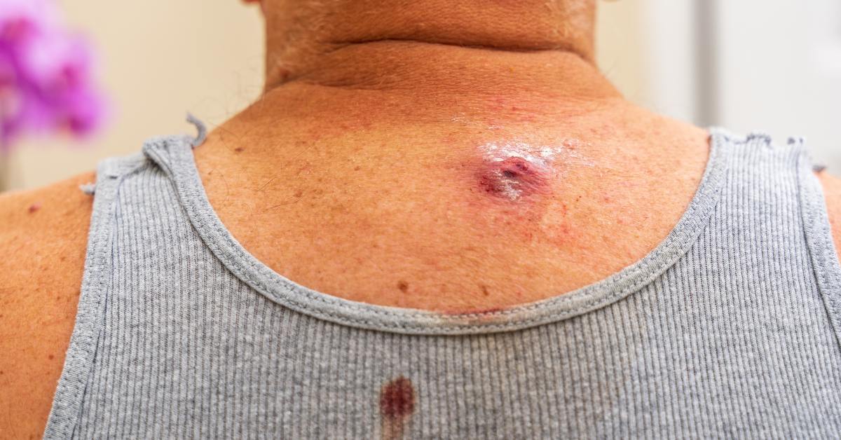 Benjolan di leher bisa disebabkan karena kista.