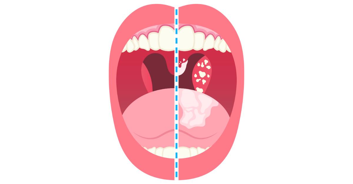 Tonsilitis adalah radang amandel.