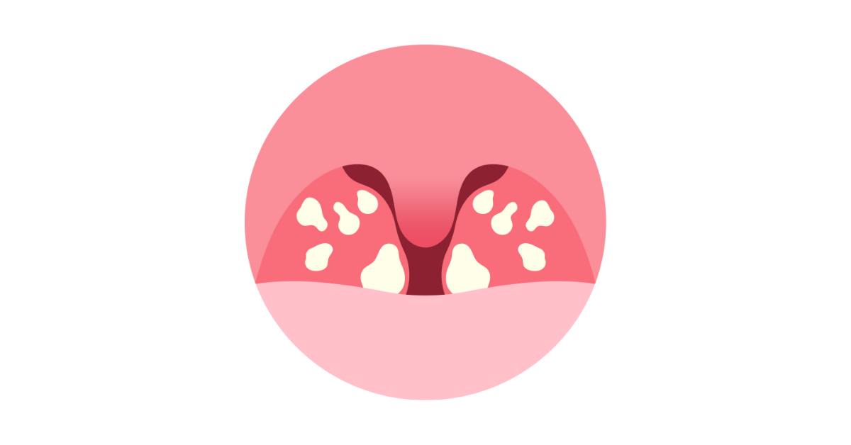 Benjolan di leher bisa terjadi karena radang amandel atau tonsilitis.