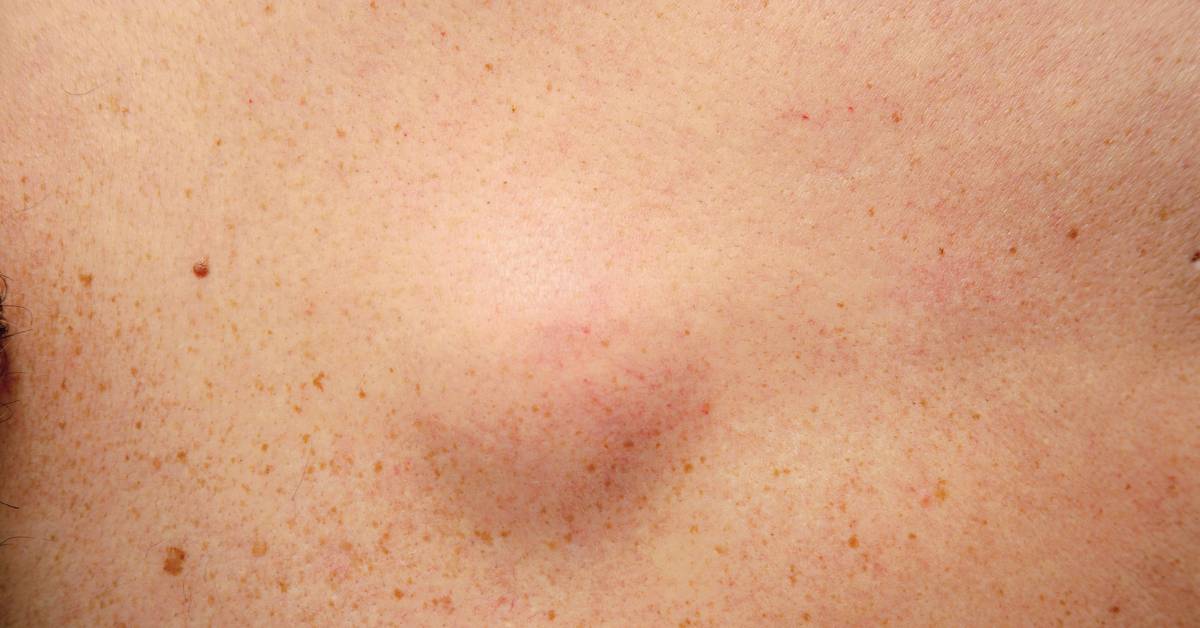 Benjolan di leher bisa disebabkan karena lipoma.