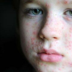 13 Cara Menghilangkan Cacar Air Dengan Cepat, Wajib Dicoba!