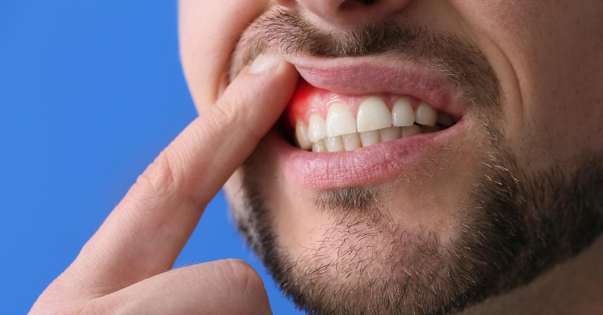 Cara agar gusi bengkak cepat kempes adalah dengan kumur air garam.