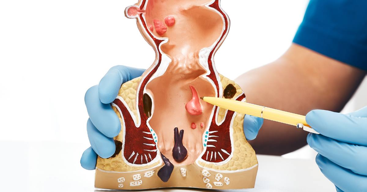 Cara mengobati ambeien adalah dengan minum obat ambeien.