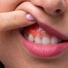 Cara Mengobati Gusi Bengkak secara Alami, Cepat Kempes!