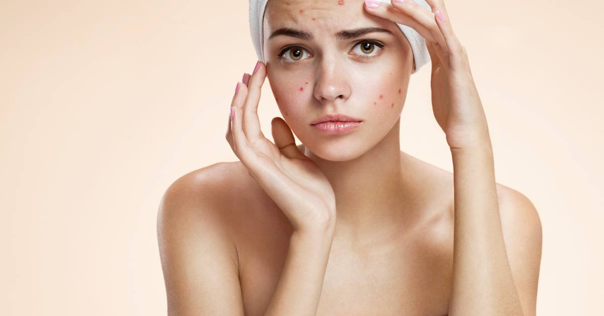 Sirih cina bisa digunakan untuk mengobati jerawat.