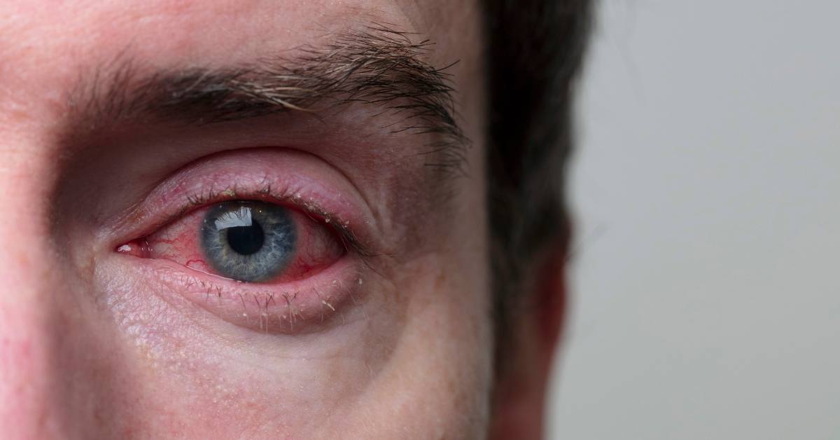 Sirih cina bisa digunakan untuk membersihkan mata.