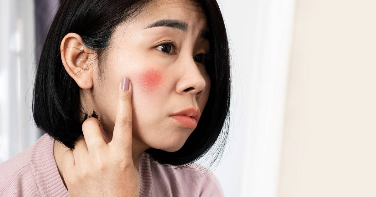 Penyebab kemerahan di wajah, di antaranya alergi, iritasi, hingga sun burn.