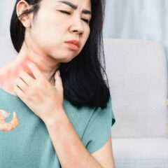 Praktis, 7 Cara Menghilangkan Biduran dengan Cepat dan Alami