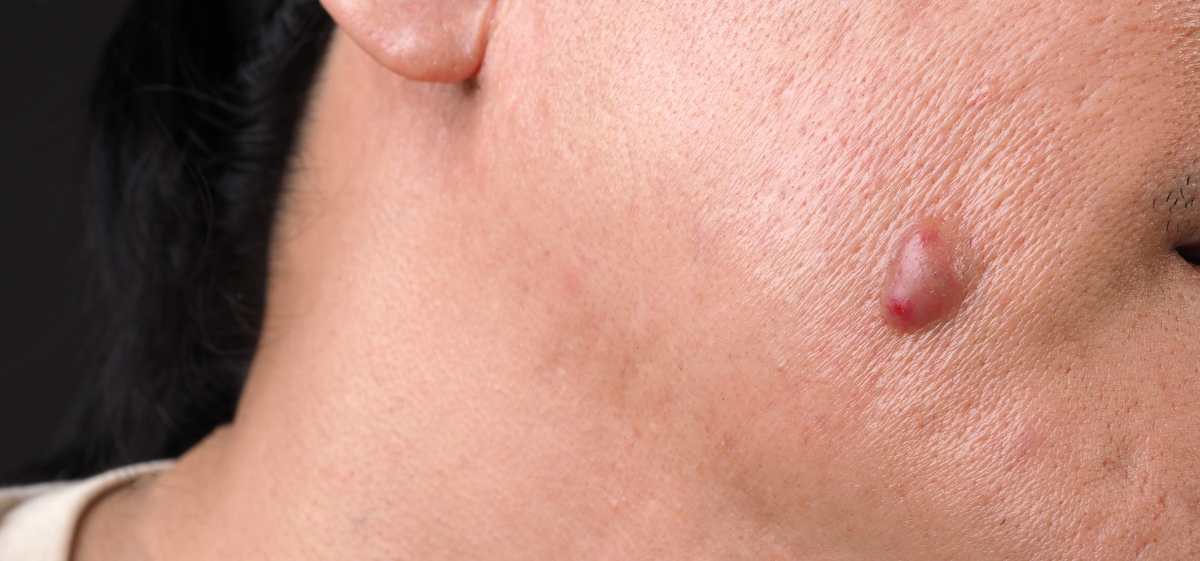 Penyebab Timbulnya Bisul
Berdasarkan keterangan dari Health, bisul biasanya muncul karena suatu kondisi yang disebut folliculitis, yang merupakan infeksi bakteri pada folikel rambut.