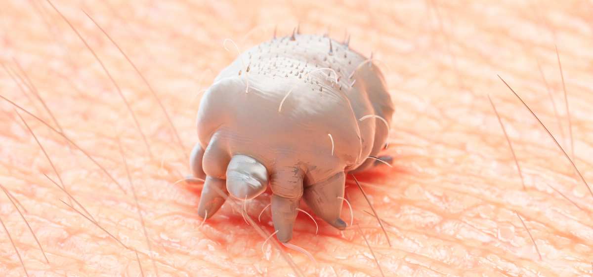 Salah satu cara membunuh kutu scabies dengan cepat yakni dengan menggunakan salep permethrin.
