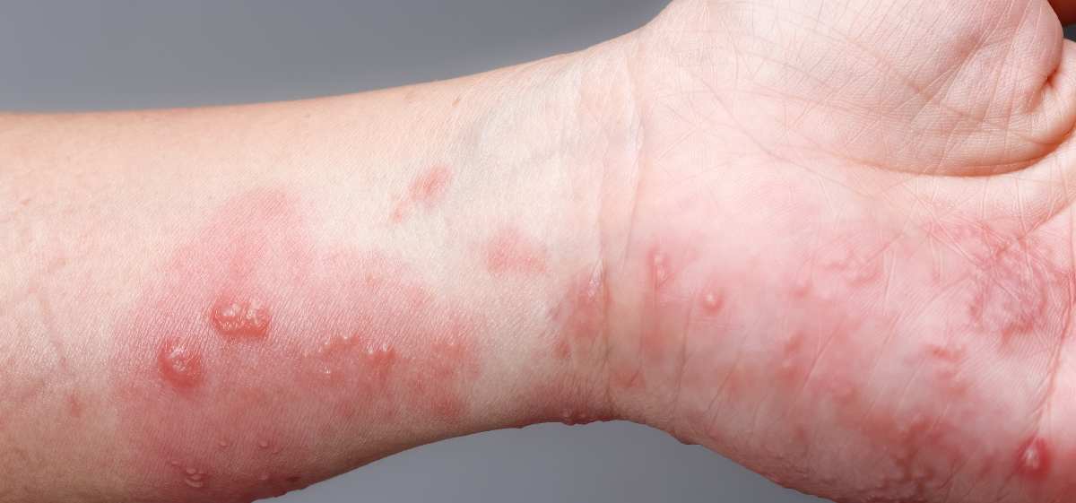 Apakah Scabies Bisa Sembuh Sendiri
Tidak, scabies jarang sembuh sendiri tanpa pengobatan yang tepat.
