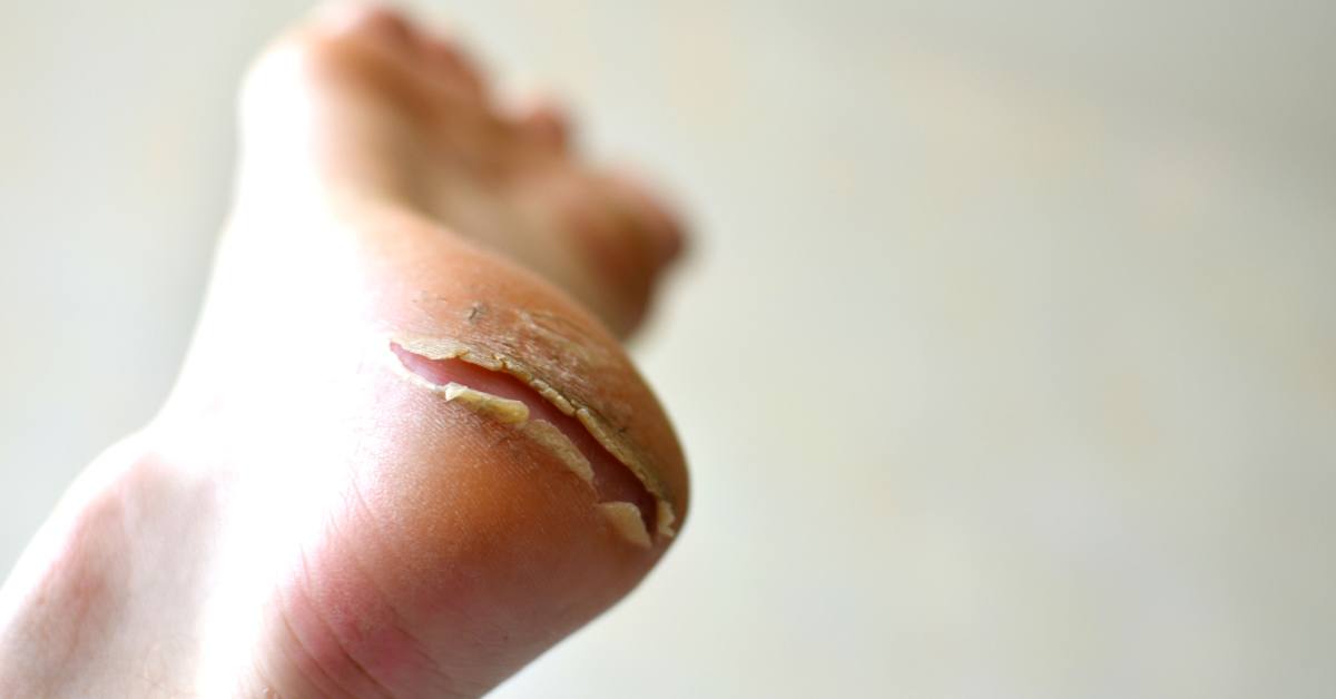 Terdapat beberapa cara menghilangkan kapalan di kaki dengan cepat, seperti merendam kaki di air garam.