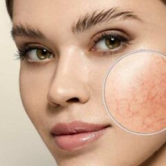 12 Cara Menghilangkan Urat di Wajah dan Penyebabnya