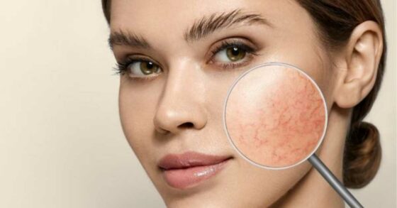 12 Cara Menghilangkan Urat di Wajah dan Penyebabnya