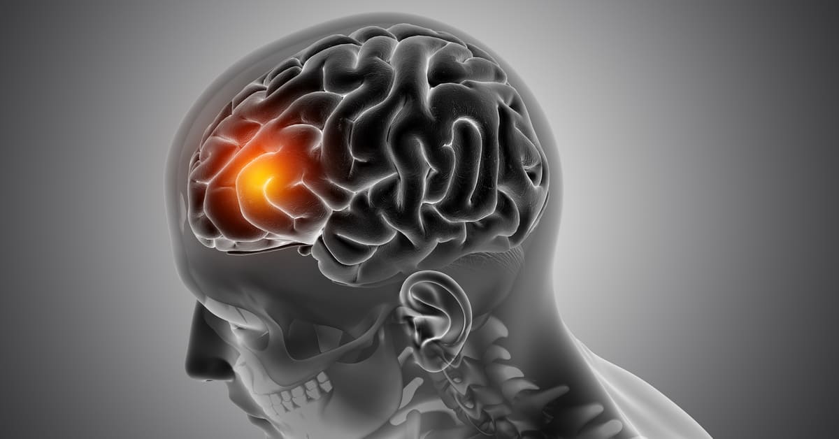 Apa Itu Tumor Otak