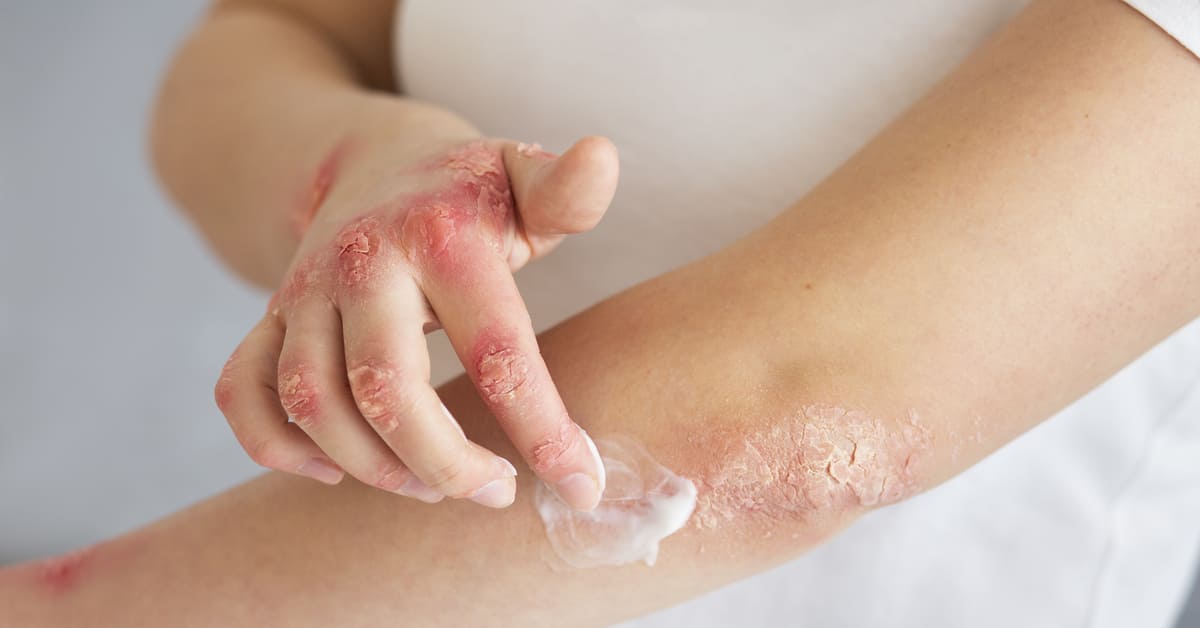 Apa obat koreng bernanah yang ampuh