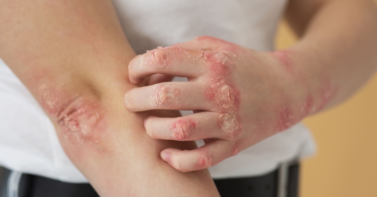 Cara Menghilangkan Koreng