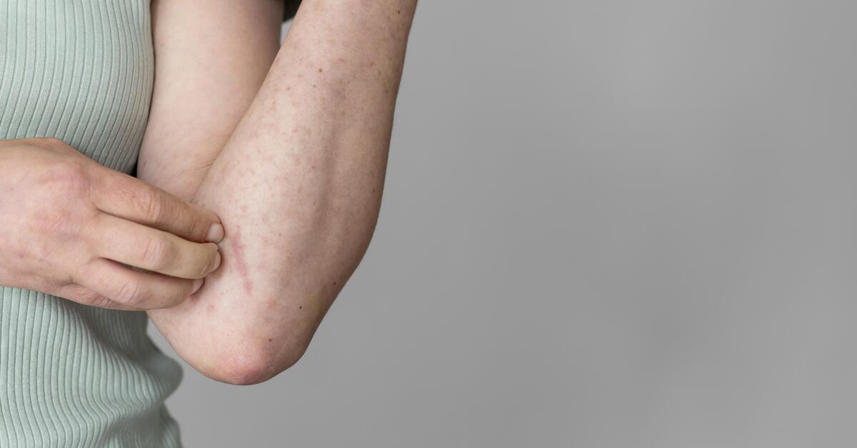 Ciri-ciri Alergi Kulit