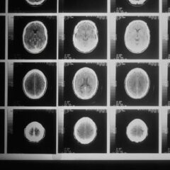 Kenali Apa Itu Penyakit Tumor: Penyebab, Gejala, dan Cara Pengobatannya