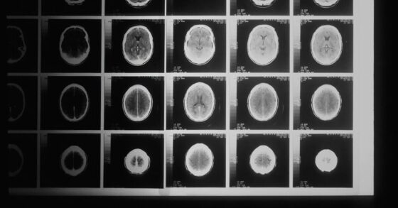 Kenali Apa Itu Penyakit Tumor: Penyebab, Gejala, dan Cara Pengobatannya