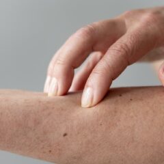 8 Penyebab Alergi Kulit dan Jenisnya yang Wajib Diketahui