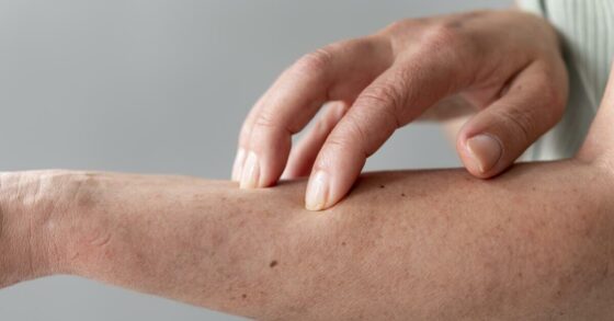 8 Penyebab Alergi Kulit dan Jenisnya yang Wajib Diketahui