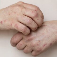 8 Gejala Penyakit Autoimun Yang Perlu Diwaspadai, Terutama Bagi Kaum Wanita!