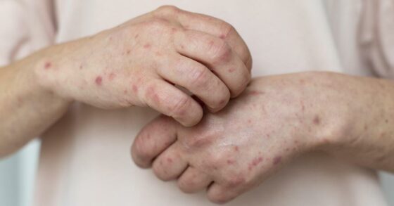 8 Gejala Penyakit Autoimun Yang Perlu Diwaspadai, Terutama Bagi Kaum Wanita!