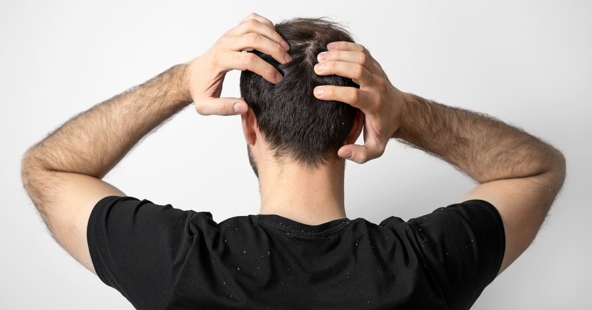 Apa itu Ketombe Kering